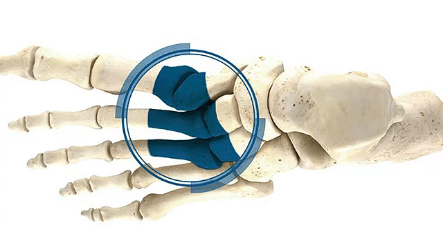 lesion fractura de lisfranc